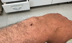 İtfaiye erinin koluna yapışan kene hastanede çıkarıldı