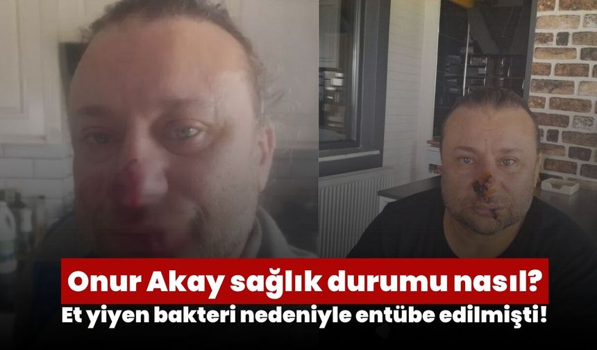 Onur Akay sağlık durumu nasıl? Et yiyen bakteri nedeniyle entübe edilmişti!